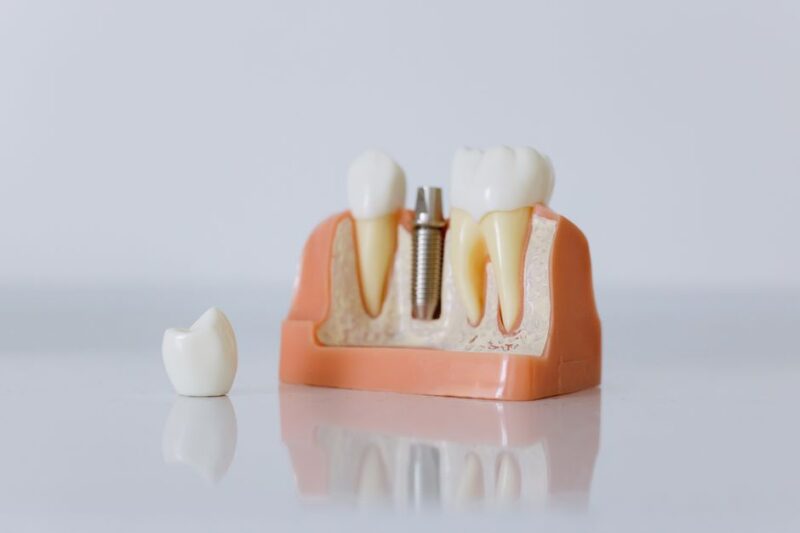 Todo lo que debes saber sobre el precio de los implantes dentales